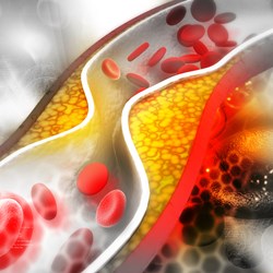 Image for Cholesterol, reducing your risk of complications