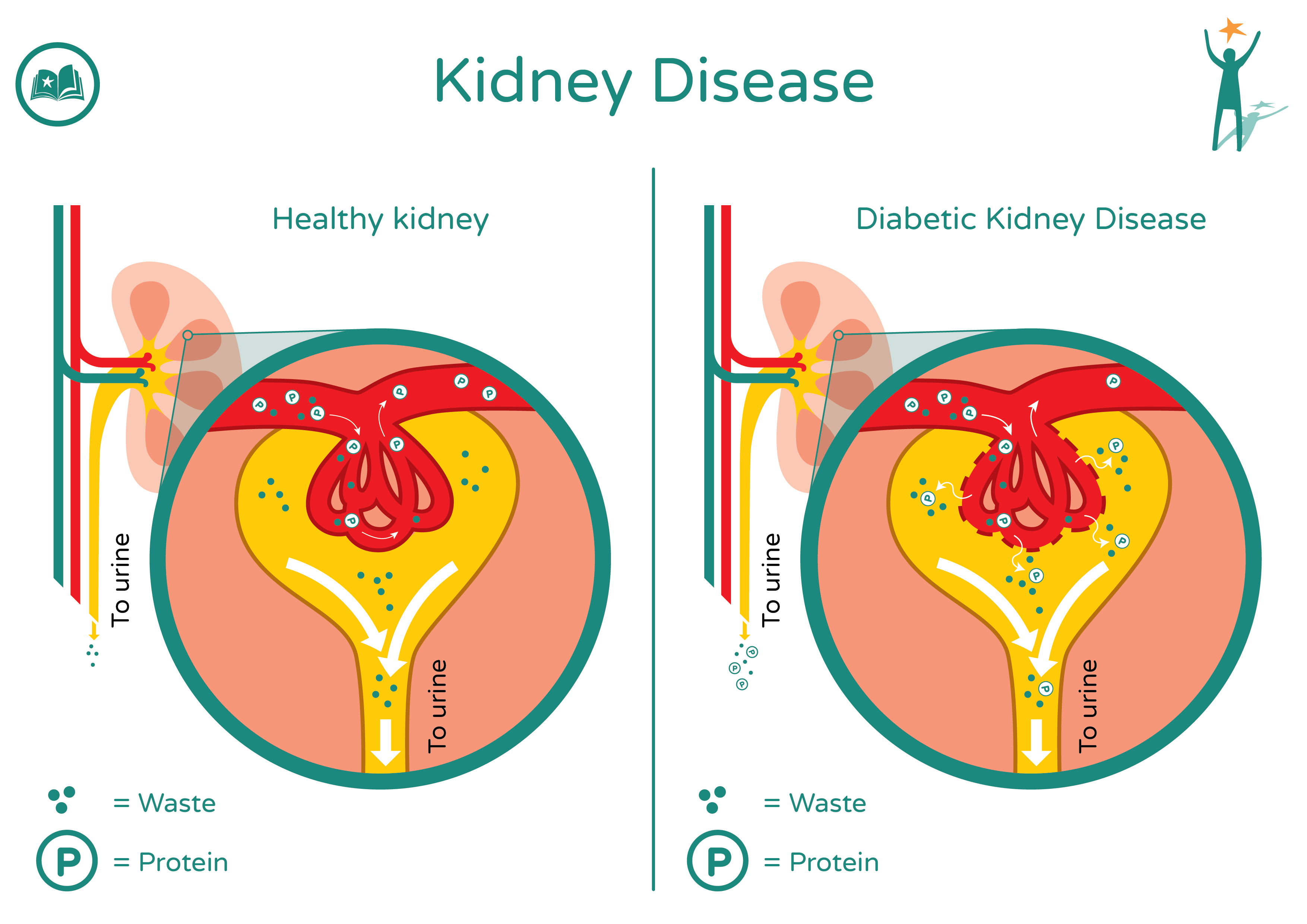 Does High Blood Sugar Cause Kidney Damage