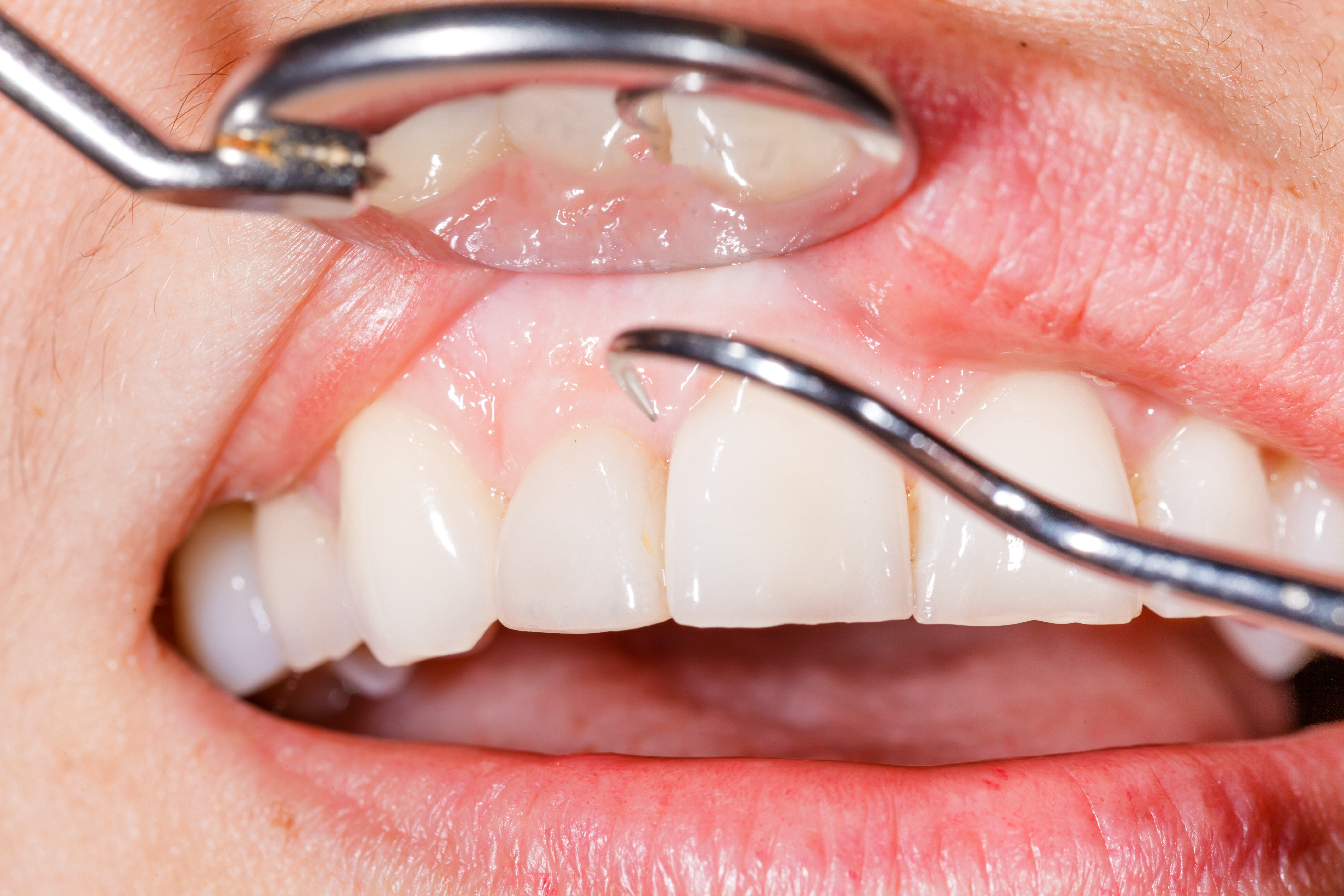 Image for Diabetes and Gum Disease